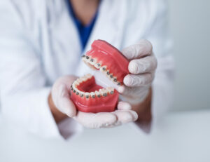 doctor orthodontist shows how the system of braces on teeth is arranged