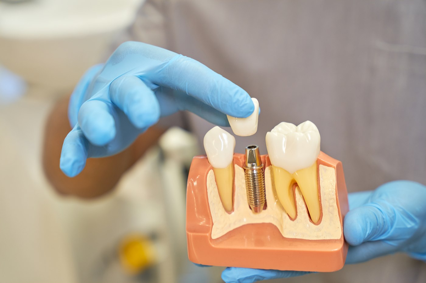 Dental implant model held in a gloved hand