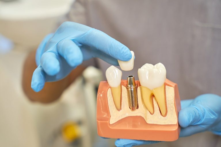 Dental implant model held in a gloved hand